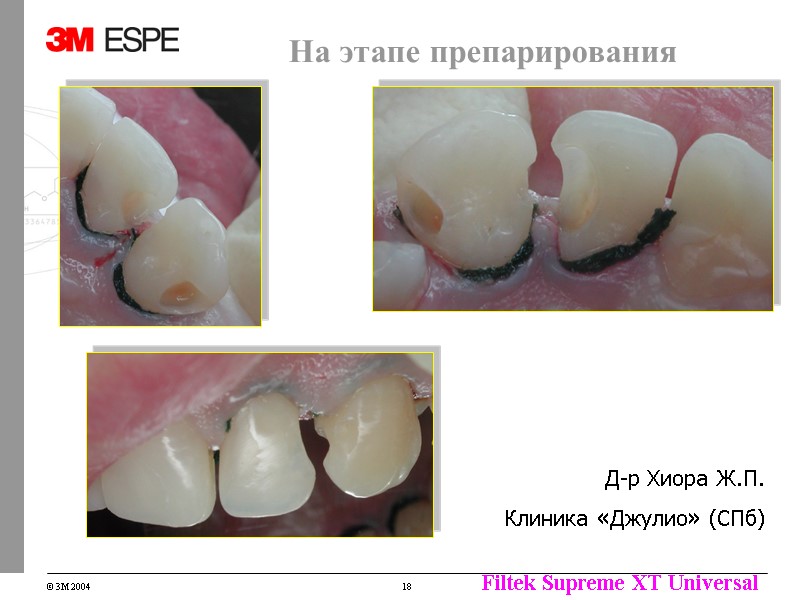 Д-р Хиора Ж.П. Клиника «Джулио» (СПб) На этапе препарирования Д-р Хиора Ж.П. Клиника «Джулио» (СПб) На этапе препарирования